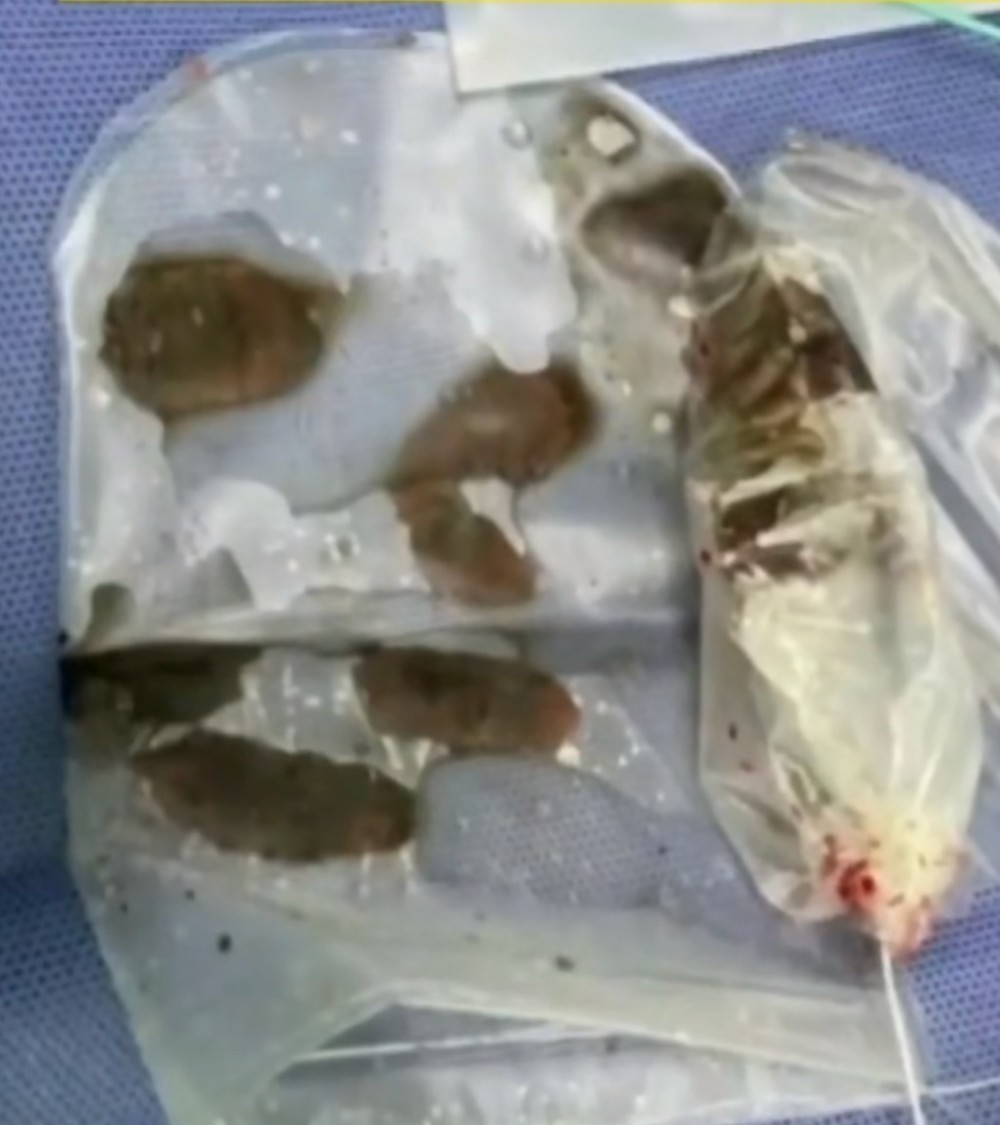 男子生食偏好引发胆道寄生虫感染，警惕饮食习惯与健康风险