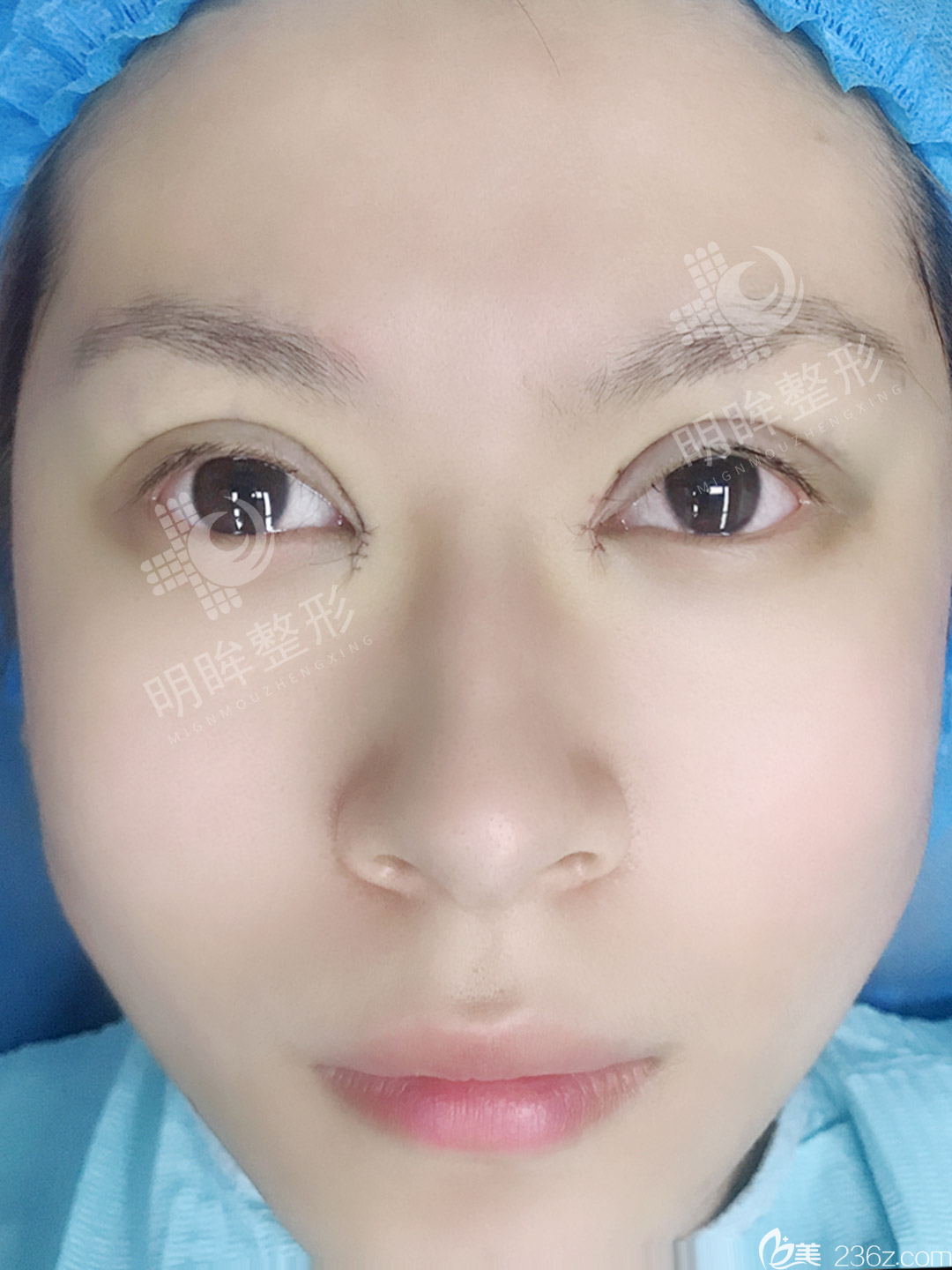 双眼皮新技术揭秘，小明的魔法双眼皮之旅